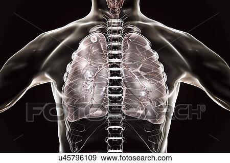 Secondary tuberculosis infection. Computer illustration showing small-sized solid nodular mass located in the upper lobe of right lung near lung apex. View Large Photo Image Stock Photo - Secondary tuberculosis infection. Computer illustration showing small-sized solid nodular mass located in the upper lobe of right lung near lung apex.. Fotosearch
