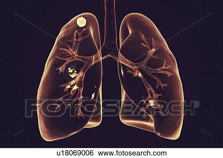 Secondary tuberculosis infection. Computer illustration showing small-sized solid nodular mass located in the upper lobe of right lung near lung apex. View Large Photo Image Stock Photograph - Secondary tuberculosis infection. Computer illustration showing small-sized solid nodular mass located in the upper lobe of right lung near lung apex.. Fotosearch