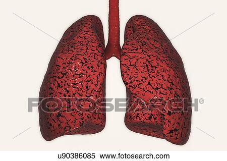 Stock Photography - Smoker's lungs, computer illustration.. Fotosearch