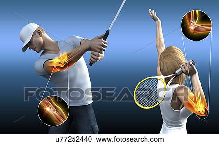 Stock Image - Sports elbow injuries, computer illustration.. Fotosearch