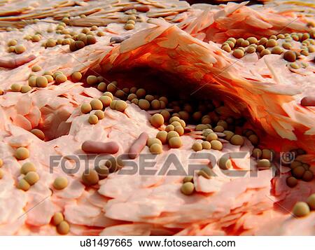 Stock Photography - Staphylococcal neurodermatitis. Illustration of bacterial infection of the skin in a case of neurodermatitis. Neurodermatitis typically starts with skin inflammation or infection causing the skin to itch. However, scratching makes the affected area of.... Fotosearch