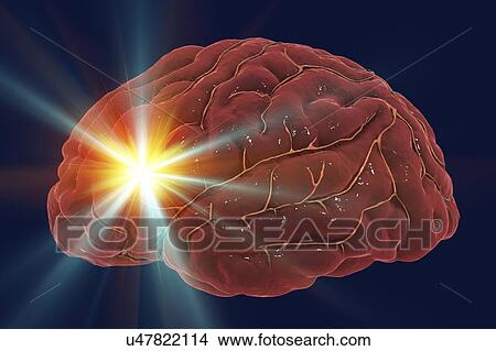Stroke, computer illustration. View Large Photo Image Picture - Stroke, computer illustration.. Fotosearch