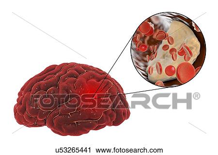 Stock Image - Stroke, computer illustration.. Fotosearch