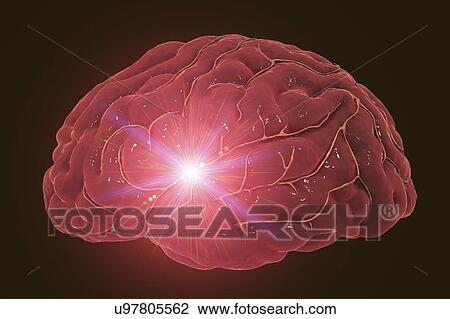 Stroke, computer illustration. View Large Photo Image Stock Image - Stroke, computer illustration.. Fotosearch