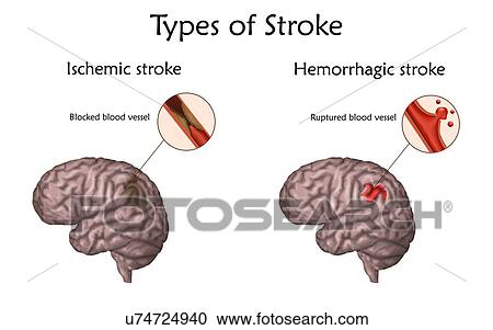 Stock Image - Stroke types, illustration. Blocked blood vessel causing an ischemic stroke and ruptured blood vessel causing a haemorrhagic stroke.. Fotosearch