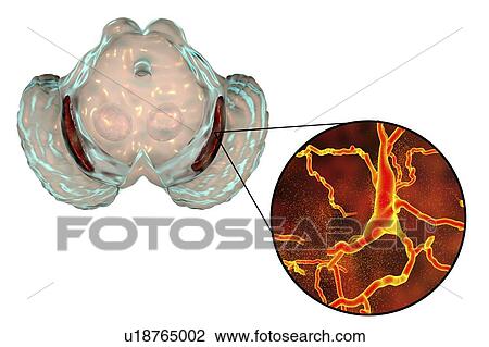 Substantia nigra. Computer illustration showing a degenerated substantia nigra and dopaminergic neurons in Parkinson's disease. The substantia nigra plays an important role in reward, addiction, and movement. Degeneration of this structure is... View Large Photo Image Stock Image - Substantia nigra. Computer illustration showing a degenerated substantia nigra and dopaminergic neurons in Parkinson's disease. The substantia nigra plays an important role in reward, addiction, and movement. Degeneration of this structure is.... Fotosearch