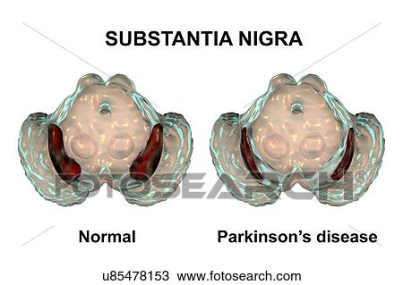 Substantia nigra. Computer illustration showing a healthy substantia nigra (top) and degenerated substantia nigra (bottom) from human brains. The substantia nigra plays an important role in reward, addiction, and movement. Degeneration of this... View Large Photo Image Stock Image - Substantia nigra. Computer illustration showing a healthy substantia nigra (top) and degenerated substantia nigra (bottom) from human brains. The substantia nigra plays an important role in reward, addiction, and movement. Degeneration of this.... Fotosearch