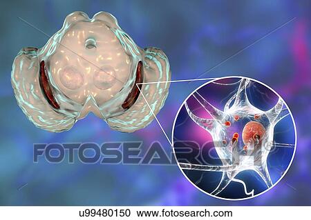 Substantia nigra. Computer illustration showing a degenerated substantia nigra in Parkinson's disease. The substantia nigra plays an important role in reward, addiction, and movement. Degeneration of this structure is characteristic of Parkinson's... View Large Photo Image Stock Image - Substantia nigra. Computer illustration showing a degenerated substantia nigra in Parkinson's disease. The substantia nigra plays an important role in reward, addiction, and movement. Degeneration of this structure is characteristic of Parkinson's.... Fotosearch