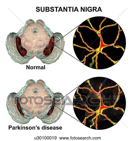 Stock Photo - Substantia nigra. Computer illustration showing a healthy substantia nigra (top) and degenerated substantia nigra (bottom) from human brains. The substantia nigra plays an important role in reward, addiction, and movement. Degeneration of this.... Fotosearch