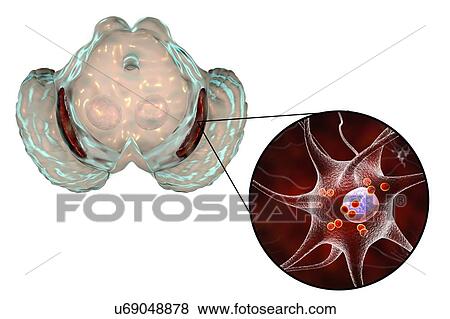 Substantia nigra. Computer illustration showing a degenerated substantia nigra in Parkinson's disease. The substantia nigra plays an important role in reward, addiction, and movement. Degeneration of this structure is characteristic of Parkinson's... View Large Photo Image Stock Photo - Substantia nigra. Computer illustration showing a degenerated substantia nigra in Parkinson's disease. The substantia nigra plays an important role in reward, addiction, and movement. Degeneration of this structure is characteristic of Parkinson's.... Fotosearch