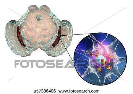 Substantia nigra. Computer illustration showing a degenerated substantia nigra in Parkinson's disease. The substantia nigra plays an important role in reward, addiction, and movement. Degeneration of this structure is characteristic of Parkinson's... View Large Photo Image Stock Photograph - Substantia nigra. Computer illustration showing a degenerated substantia nigra in Parkinson's disease. The substantia nigra plays an important role in reward, addiction, and movement. Degeneration of this structure is characteristic of Parkinson's.... Fotosearch