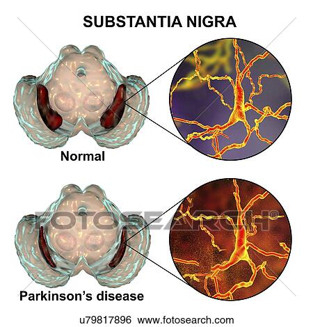 Substantia nigra. Computer illustration showing a healthy substantia nigra (top) and degenerated substantia nigra (bottom) from human brains. The substantia nigra plays an important role in reward, addiction, and movement. Degeneration of this... View Large Photo Image Stock Photograph - Substantia nigra. Computer illustration showing a healthy substantia nigra (top) and degenerated substantia nigra (bottom) from human brains. The substantia nigra plays an important role in reward, addiction, and movement. Degeneration of this.... Fotosearch