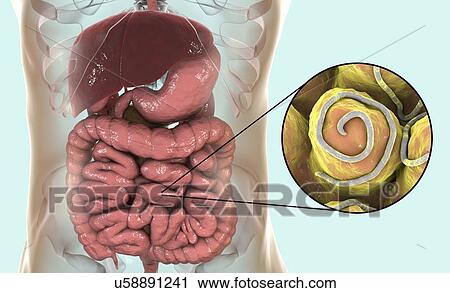 Stock Image - Threadworm infection. Computer illustration showing multiple threadworms (Enterobius sp. ) in the human intestine. Threadworms are nematode worms that parasitize the large intestine and caecum of many animals. In humans they cause the common infection.... Fotosearch