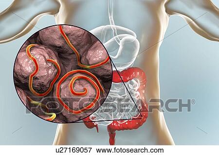 Stock Photo - Threadworm infection. Computer illustration showing multiple threadworms (Enterobius sp. ) in the human intestine. Threadworms are nematode worms that parasitize the large intestine and caecum of many animals. In humans they cause the common infection.... Fotosearch