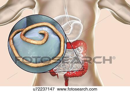 Stock Photo - Threadworm infection. Computer illustration showing multiple threadworms (Enterobius sp. ) in the human intestine. Threadworms are nematode worms that parasitize the large intestine and caecum of many animals. In humans they cause the common infection.... Fotosearch