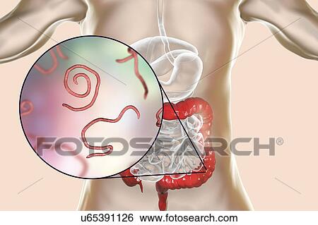 Stock Photograph - Threadworm infection. Computer illustration showing multiple threadworms (Enterobius sp. ) in the human intestine. Threadworms are nematode worms that parasitize the large intestine and caecum of many animals. In humans they cause the common infection.... Fotosearch