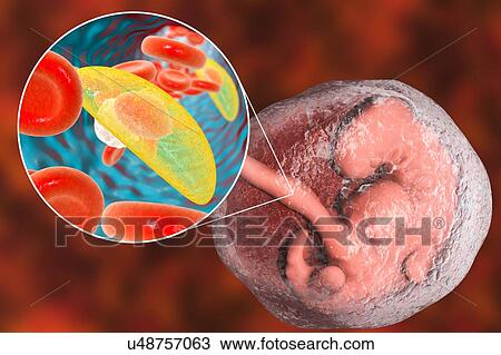 Stock Image - Transplacental transmission of Toxoplasma gondii parasites to human embryo, conceptual illustration. T. gondii is a species of parasitic protozoa that can be carried by all known mammals. It causes toxoplasmosis, a usually minor and self-limiting.... Fotosearch