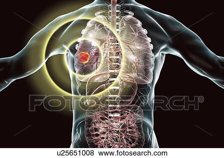 Treatment and prevention of lung cancer, conceptual computer illustration. View Large Photo Image Stock Photo - Treatment and prevention of lung cancer, conceptual computer illustration.. Fotosearch