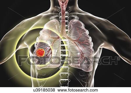 Stock Photo - Treatment and prevention of lung cancer, conceptual computer illustration.. Fotosearch