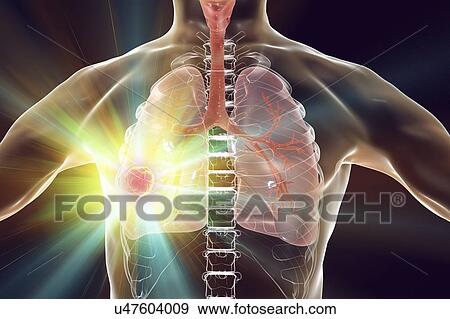 Treatment and prevention of lung cancer, conceptual computer illustration. View Large Photo Image Stock Photo - Treatment and prevention of lung cancer, conceptual computer illustration.. Fotosearch