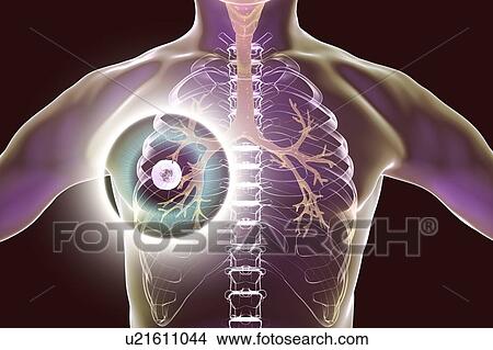 Picture - Treatment and prevention of pulmonary tuberculosis, conceptual computer illustration. Highlighted cavern (cavity) in the right lung with a well-formed fibrous layer in its wall.. Fotosearch