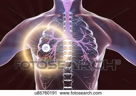 Stock Image - Treatment and prevention of pulmonary tuberculosis, conceptual computer illustration. Highlighted cavern (cavity) in the right lung with a well-formed fibrous layer in its wall.. Fotosearch