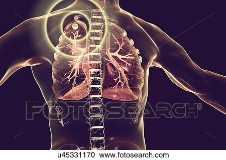 Stock Image - Treatment and prevention of tuberculosis, conceptual illustration.. Fotosearch