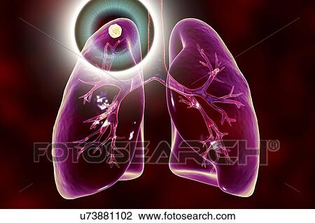 Stock Image - Treatment and prevention of tuberculosis, conceptual illustration.. Fotosearch