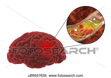 Treatment and prevention of stroke due to atherosclerosis. Conceptual illustration showing an arterial blockage (expanded view at upper right) causing a stroke (cerebrovascular accident, CVA). This stroke is due to a build-up of the plaque that forms... View Large Photo Image Stock Photography - Treatment and prevention of stroke due to atherosclerosis. Conceptual illustration showing an arterial blockage (expanded view at upper right) causing a stroke (cerebrovascular accident, CVA). This stroke is due to a build-up of the plaque that forms.... Fotosearch