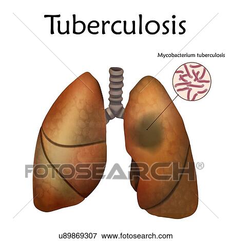 Tuberculosis, illustration. An infectious disease caused by the bacterium Mycobacterium tuberculosis. View Large Photo Image Stock Photo - Tuberculosis, illustration. An infectious disease caused by the bacterium Mycobacterium tuberculosis.. Fotosearch