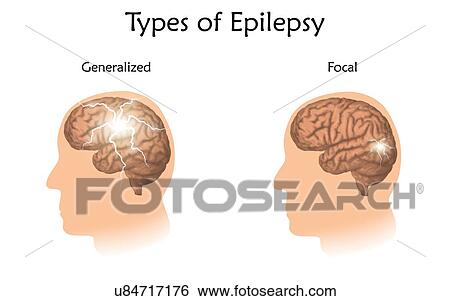 Stock Photograph - Types of epilepsy. Illustration showing generalized and focal epilepsy.. Fotosearch