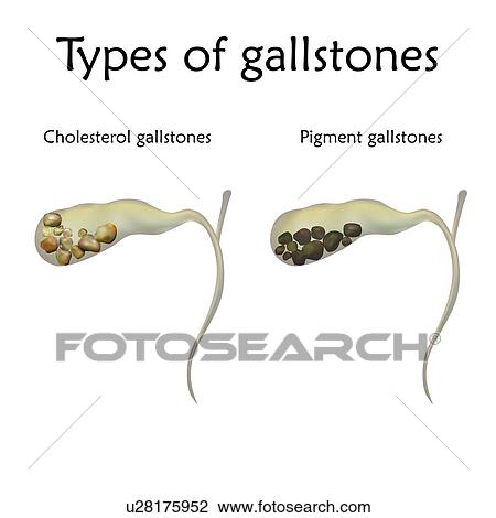 Types of gallstones. Illustration showing cholesterol and pigment gallstones. View Large Photo Image Stock Image - Types of gallstones. Illustration showing cholesterol and pigment gallstones.. Fotosearch