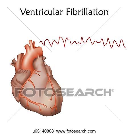 Stock Photo - Ventricular fibrillation, illustration.. Fotosearch
