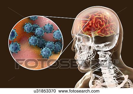Viral encephalitis. Conceptual illustration showing brain with signs of encephalitis inside human body and close-up view of viruses. View Large Photo Image Stock Image - Viral encephalitis. Conceptual illustration showing brain with signs of encephalitis inside human body and close-up view of viruses.. Fotosearch