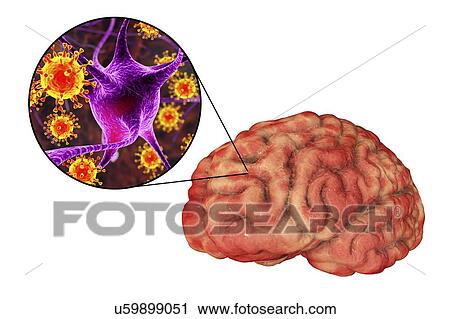 Viral encephalitis. Conceptual illustration showing brain with signs of encephalitis inside human body and close-up view of viruses. View Large Photo Image Stock Image - Viral encephalitis. Conceptual illustration showing brain with signs of encephalitis inside human body and close-up view of viruses.. Fotosearch
