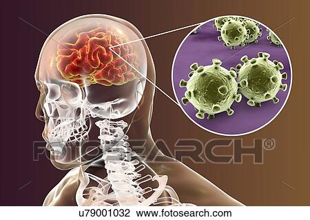 Viral encephalitis. Conceptual illustration showing brain with signs of encephalitis inside human body and close-up view of viruses. View Large Photo Image Stock Image - Viral encephalitis. Conceptual illustration showing brain with signs of encephalitis inside human body and close-up view of viruses.. Fotosearch
