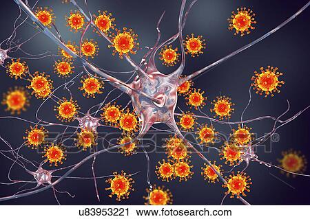 Stock Image - Viral encephalitis. Conceptual illustration showing viruses infecting neurons.. Fotosearch