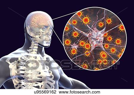 Stock Image - Viral encephalitis. Conceptual illustration showing brain with signs of encephalitis inside human body and close-up view of viruses.. Fotosearch