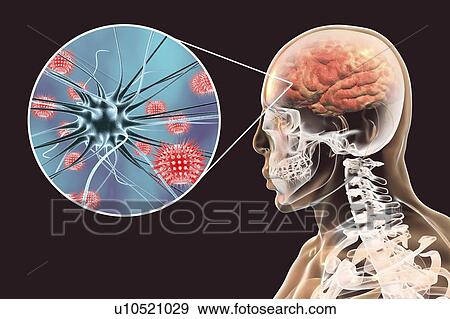 Stock Photo - Viral encephalitis. Conceptual illustration showing brain with signs of encephalitis inside human body and close-up view of viruses.. Fotosearch