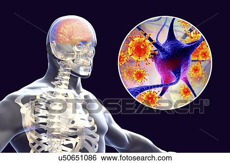 Stock Photograph - Viral encephalitis. Conceptual illustration showing brain with signs of encephalitis inside human body and close-up view of viruses.. Fotosearch