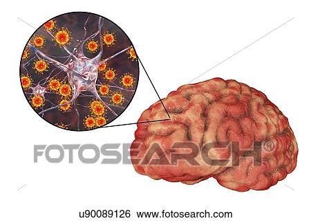 Viral encephalitis. Conceptual illustration showing brain with signs of encephalitis inside human body and close-up view of viruses. View Large Photo Image Stock Photograph - Viral encephalitis. Conceptual illustration showing brain with signs of encephalitis inside human body and close-up view of viruses.. Fotosearch