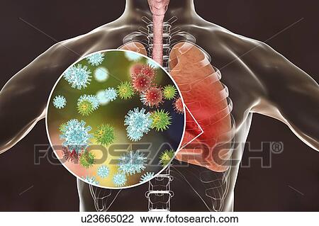 Stock Image - Viral pneumonia, conceptual illustration. Human lungs and close-up view of viruses, the causative agents of pneumonia. Pneumonia can be caused by many types of viruses, including Influenza, MERS, SARS, Adenoviruses and others.. Fotosearch