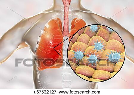 Stock Photo - Viral pneumonia, conceptual illustration. Human lungs and close-up view of viruses, the causative agents of pneumonia. Pneumonia can be caused by many types of viruses, including Influenza, MERS, SARS, Adenoviruses and others.. Fotosearch