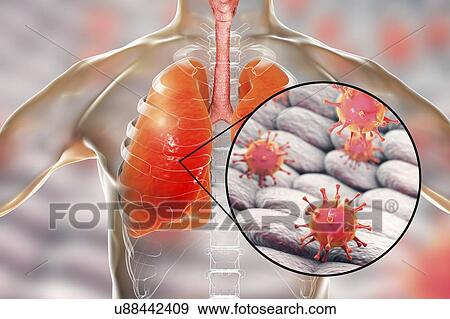 Viral pneumonia, conceptual illustration. Human lungs and close-up view of viruses, the causative agents of pneumonia. Pneumonia can be caused by many types of viruses, including Influenza, MERS, SARS, Adenoviruses and others. View Large Photo Image Stock Photo - Viral pneumonia, conceptual illustration. Human lungs and close-up view of viruses, the causative agents of pneumonia. Pneumonia can be caused by many types of viruses, including Influenza, MERS, SARS, Adenoviruses and others.. Fotosearch
