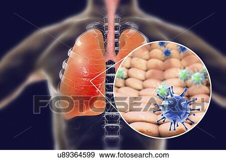 Stock Photo - Viral pneumonia, conceptual illustration. Human lungs and close-up view of viruses, the causative agents of pneumonia. Pneumonia can be caused by many types of viruses, including Influenza, MERS, SARS, Adenoviruses and others.. Fotosearch