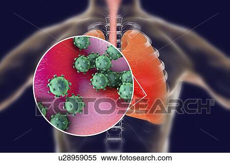 Stock Photography - Viral pneumonia, conceptual illustration. Human lungs and close-up view of viruses, the causative agents of pneumonia. Pneumonia can be caused by many types of viruses, including Influenza, MERS, SARS, Adenoviruses and others.. Fotosearch
