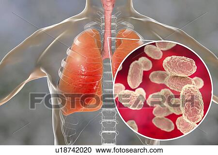 Whooping cough, conceptual illustration. Whooping cough is a highly contagious infectious disease caused by Bordetella pertussis bacteria. The main symptoms are paroxysms of cough and inspiratory whoop. B. pertussis are gram-negative, aerobic,... View Large Photo Image Stock Image - Whooping cough, conceptual illustration. Whooping cough is a highly contagious infectious disease caused by Bordetella pertussis bacteria. The main symptoms are paroxysms of cough and inspiratory whoop. B. pertussis are gram-negative, aerobic,.... Fotosearch