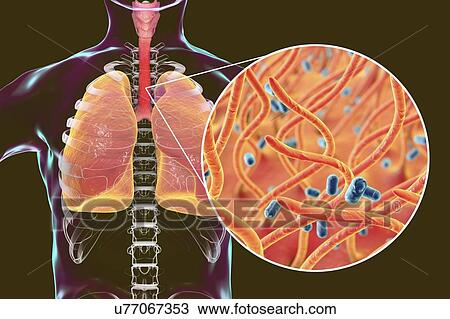 Whooping cough, conceptual illustration. Whooping cough is a highly contagious infectious disease caused by Bordetella pertussis bacteria. The main symptoms are paroxysms of cough and inspiratory whoop. B. pertussis are gram-negative, aerobic,... View Large Photo Image Stock Image - Whooping cough, conceptual illustration. Whooping cough is a highly contagious infectious disease caused by Bordetella pertussis bacteria. The main symptoms are paroxysms of cough and inspiratory whoop. B. pertussis are gram-negative, aerobic,.... Fotosearch