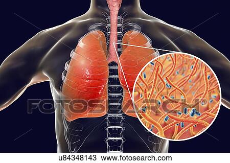 Stock Image - Whooping cough, conceptual illustration. Whooping cough is a highly contagious infectious disease caused by Bordetella pertussis bacteria. The main symptoms are paroxysms of cough and inspiratory whoop. B. pertussis are gram-negative, aerobic,.... Fotosearch