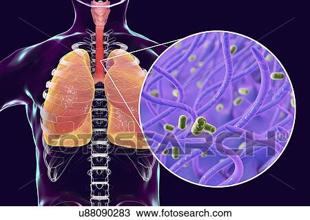 Whooping cough, conceptual illustration. Whooping cough is a highly contagious infectious disease caused by Bordetella pertussis bacteria. The main symptoms are paroxysms of cough and inspiratory whoop. B. pertussis are gram-negative, aerobic,... View Large Photo Image Stock Image - Whooping cough, conceptual illustration. Whooping cough is a highly contagious infectious disease caused by Bordetella pertussis bacteria. The main symptoms are paroxysms of cough and inspiratory whoop. B. pertussis are gram-negative, aerobic,.... Fotosearch